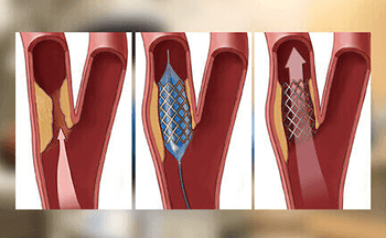 Chronic Total Occlusion (CTO) Angioplasty | Heart Block Treatment in India | Interventional Cardiologists in Bangalore - Sakra World Hospital