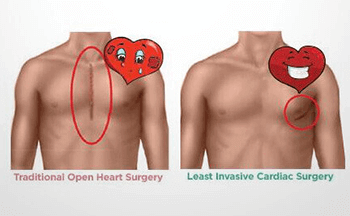 Least Invasive Cardiac Surgery | Minimal Invasive Cardiac Surgery | Best Cardiac Surgery Hospital in Bangalore - Sakra World Hospital