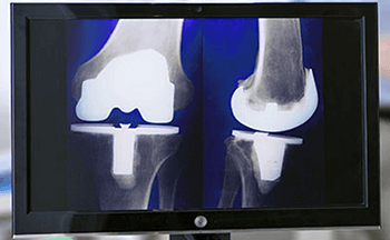 Blog on Knee Replacement Surgery - Best Orthopaedic Surgeon at Sakra