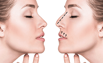 Rhinoplasty - Plastic Surgery of Nose
