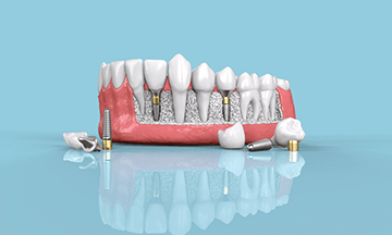 dental implants in bangalore
