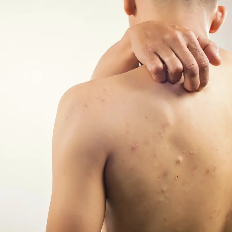 Back Acne