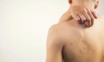 Back Acne