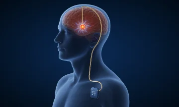 Adaptive Deep Brain Stimulation