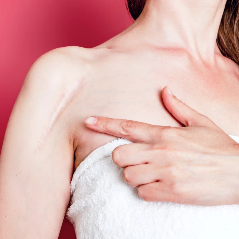 How to Remove Scars