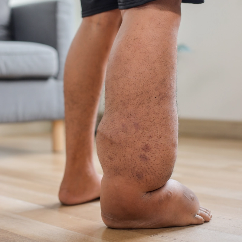 Lymphatic Filariasis