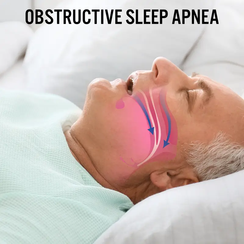 Obstructive Sleep Apnea and Stroke: Risks, Diagnosis, and Prevention