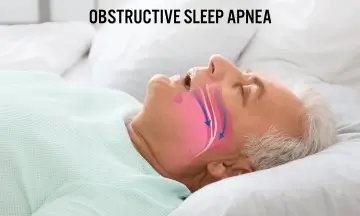 Obstructive Sleep Apnea and Stroke: Risks, Diagnosis, and Prevention