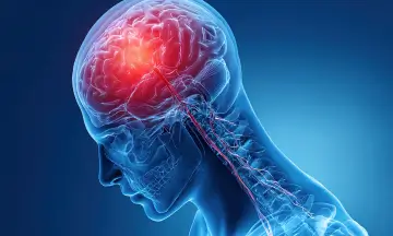 Silent Stroke