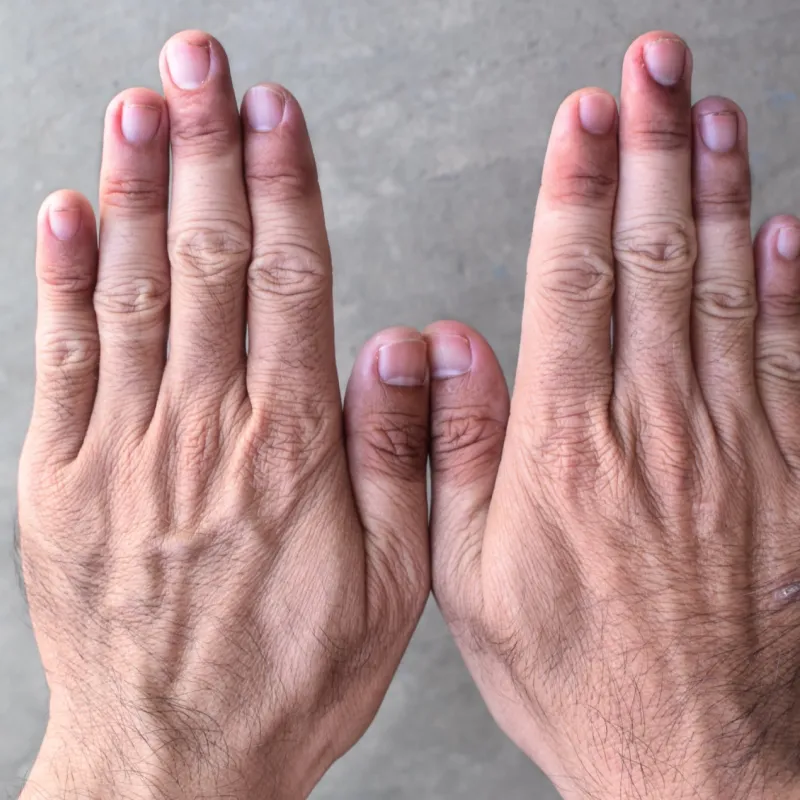 Cyanosis Symptoms