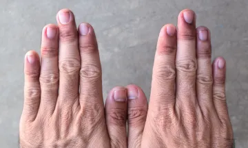 Cyanosis Symptoms