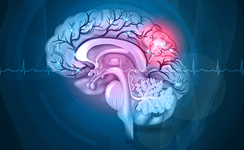 Brain Stroke - Signs, Symptoms & Treatments - Sakra World Hospital