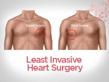 Least Invasive Heart Surgery | Minimal Invasive Cardiac Surgery Hospital In Bangalore, India - Sakra World Hospital