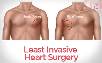 Least Invasive Heart Surgery | Minimal Invasive Cardiac Surgery Hospital In Bangalore, India - Sakra World Hospital
