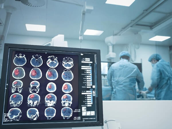 Awake Craniotomy for Brain Tumours | Best Neurosurgeons in India