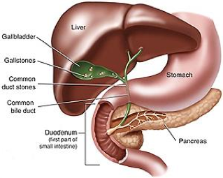 Stone gallbladder Treatment of