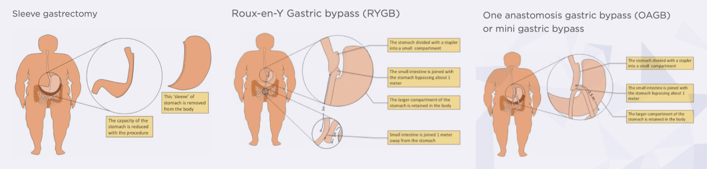 What are the different kinds of bariatric surgery