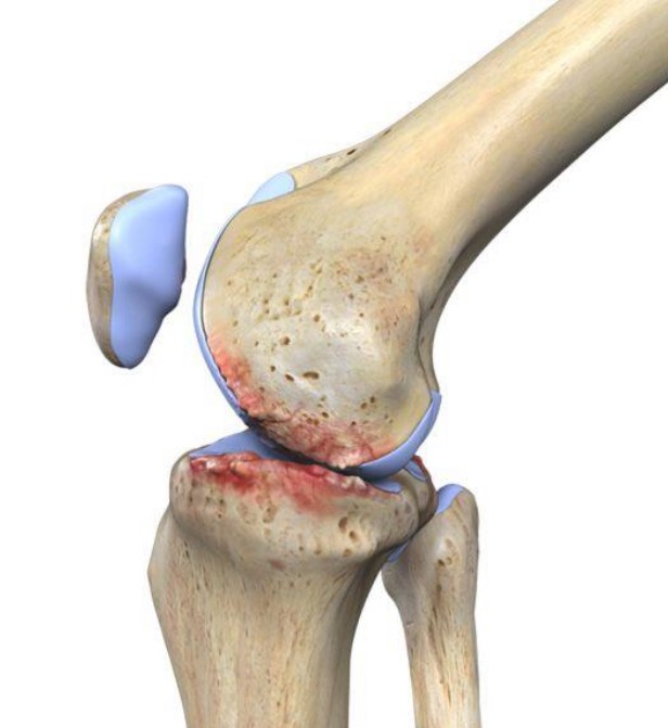 robotic knee surgery in bangalore
