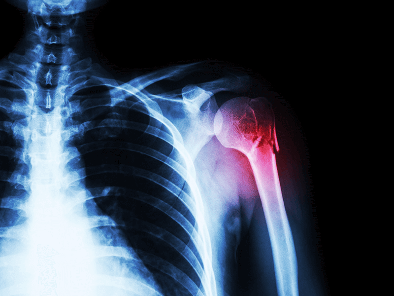 Sakra Patients Testimonials - Shoulder Surgery | Bone and Joint Specialist in Bangalore