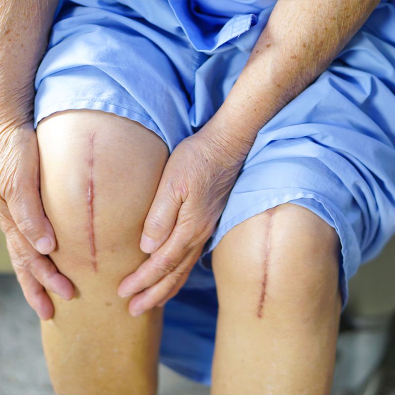 total knee replacement surgery in bangalore