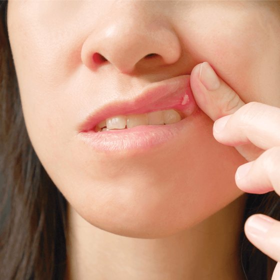 mouth ulcer specialist in bangalore