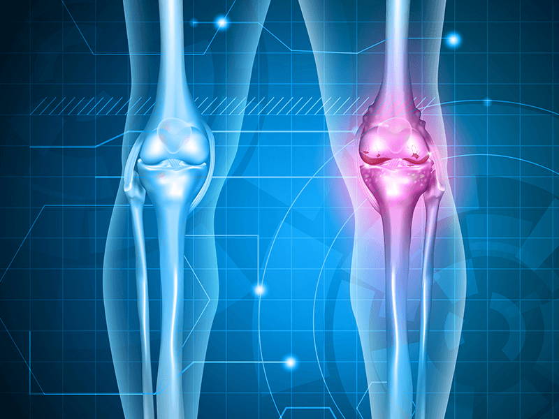 Knee Replacement Surgeons in Bangalore