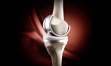 knee replacement surgery in bangalore