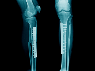  Knee Arthroscopy Surgery